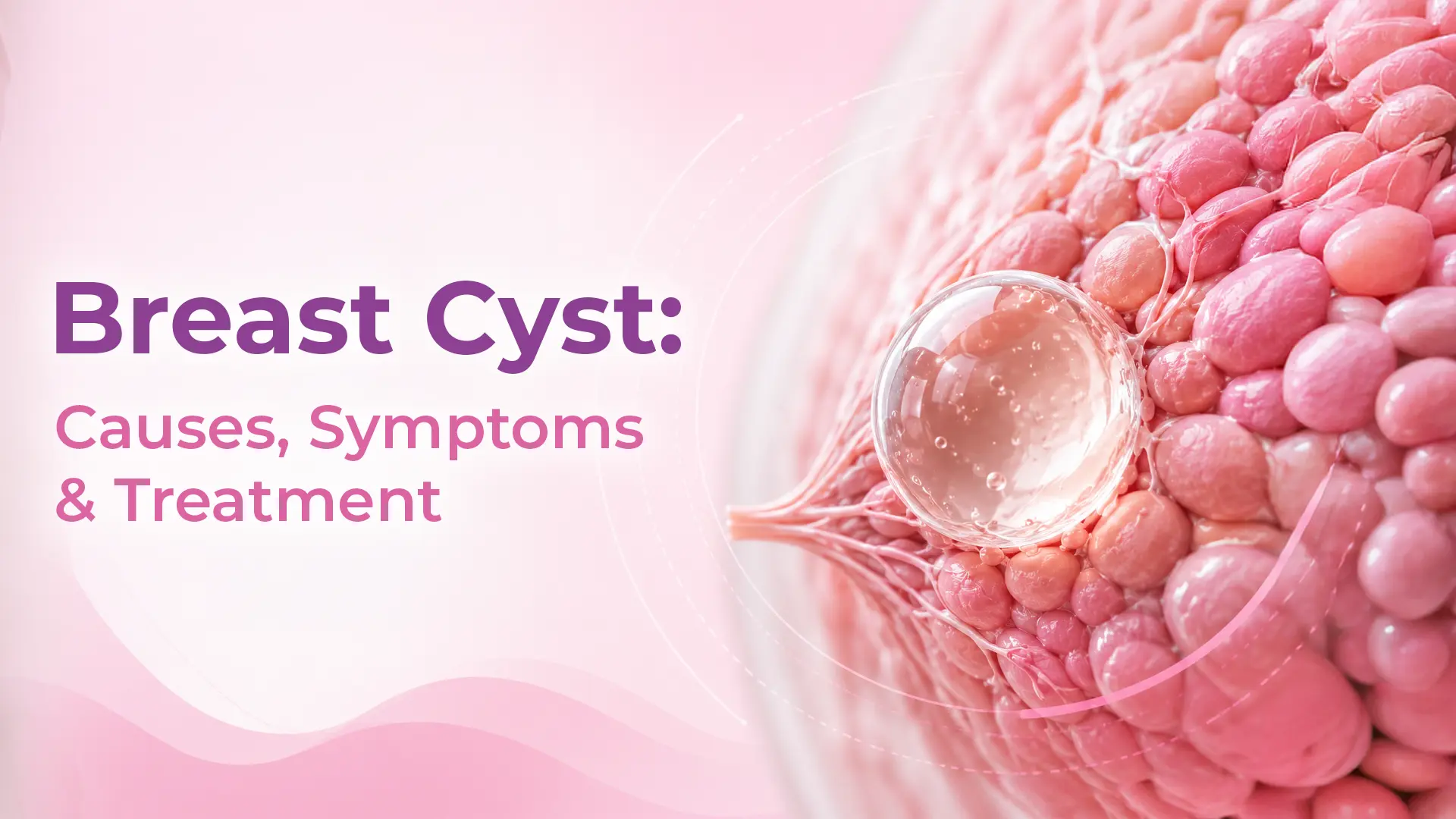 Breast Cyst: Symptoms, Causes & Treatment